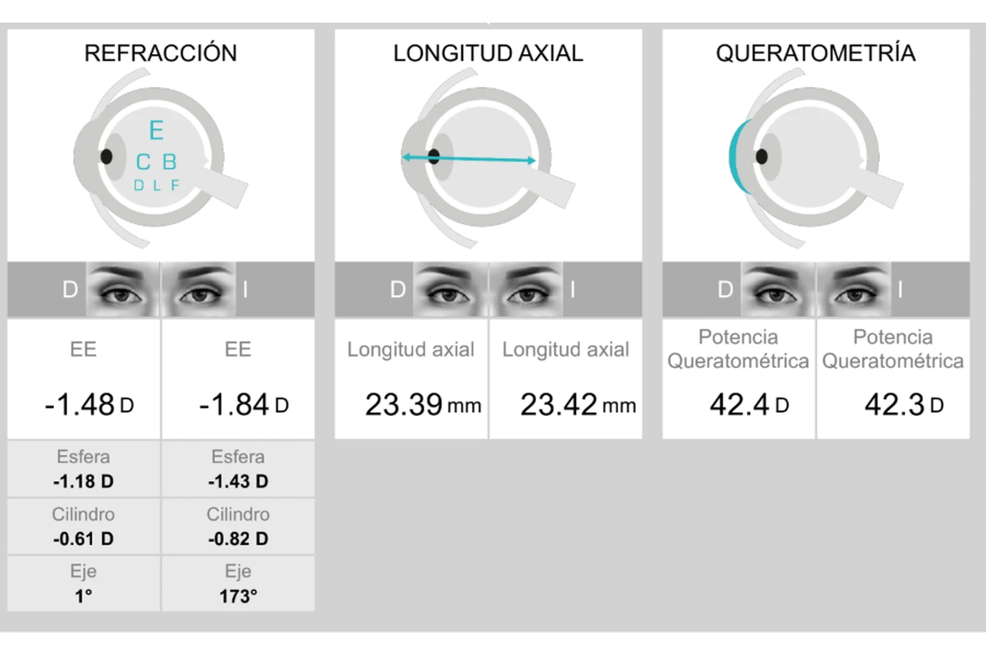 Ejemplo visual de mediciones de refracción, longitud axial y queratometría con Myopia Master