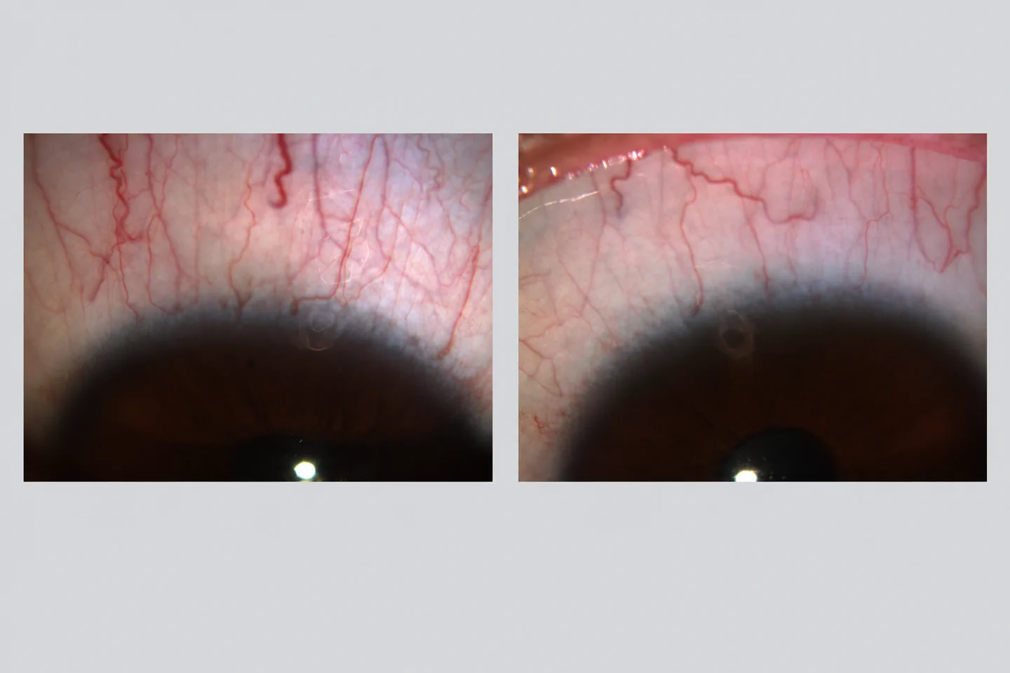Visualización educativa anonimizada de la superficie ocular con Keratograph
