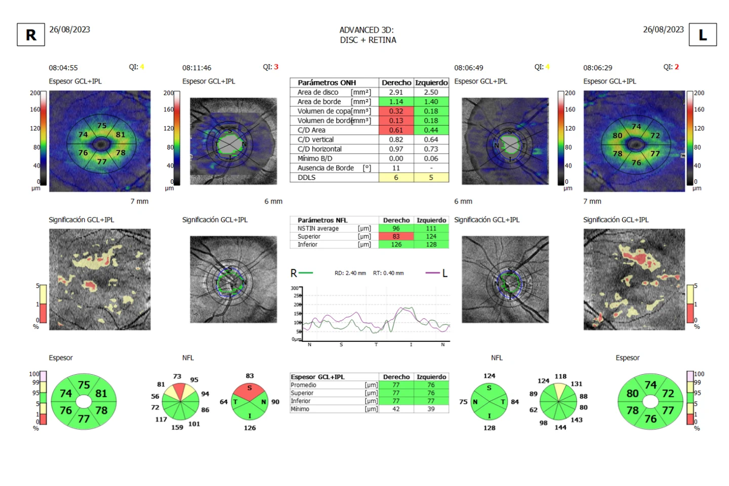 Ejemplo visual autorizado de un estudio OCT combinado de disco óptico y retina con OPTOPOL REVO